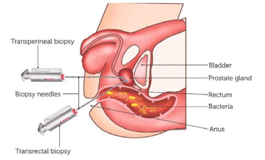 Biopsy Figure 1