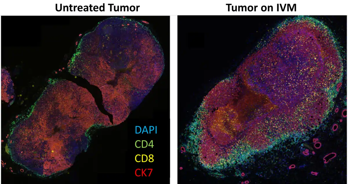 Figure 4. Staining of untreated and ivermectin (IVM)-treated breast tumours for T-cell infiltration