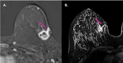 Figure 1. Magnetic resonance imaging (MRI) scans showing tumour spread along the needle biopsy path in two breast cancer patients (purple arrows).