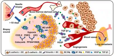Figure 3. A theoretical model of biopsy-induced metastasis (cancer spread) based on animal experiments.