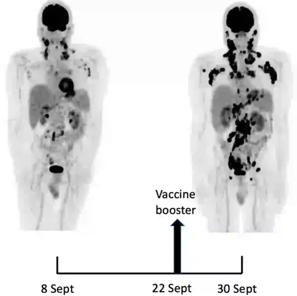 Bildgebungsscans von Dr. Goldman vor und nach seiner COVID-19-Auffrischungsimpfung. Die schwarzen Flecken zeigen Bereiche mit aktivem Lymphom